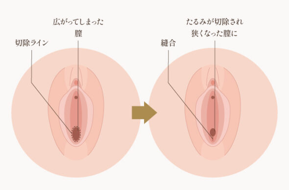 hp_膣縮小手術