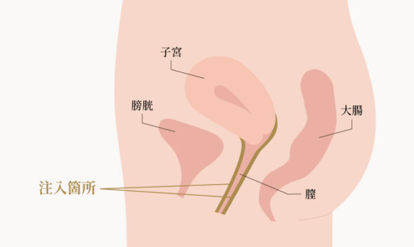memu名器形成