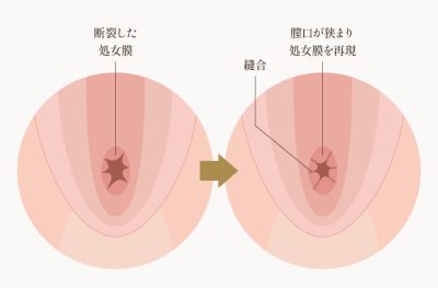 処女膜再生