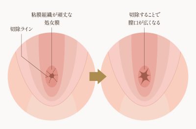処女膜切開