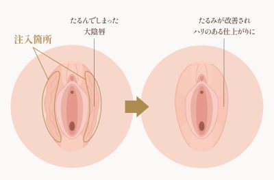 大陰唇ヒアルロン酸
