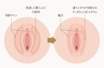 大陰唇縮小