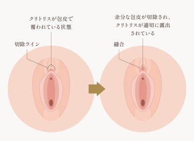 陰核包茎
